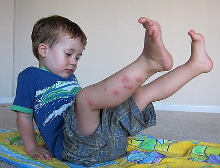 Barnet blev bidt af myg: hvad skal man lave?